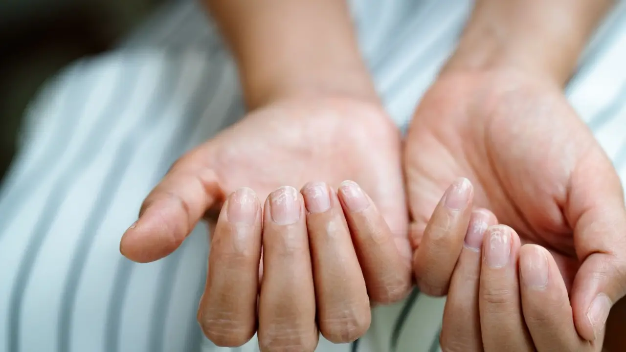 Riduci il gonfiore alle mani evitando questi errori alimentari tipici Riduci il gonfiore alle mani evitando questi errori alimentari tipici
